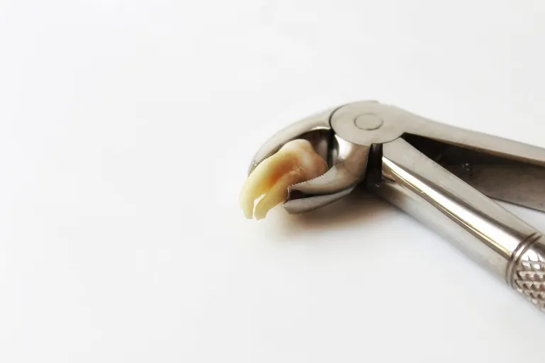 Can You Drink Coffee After Wisdom Teeth Removal? The Facts