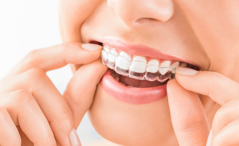 Woman wearing invisible aligner